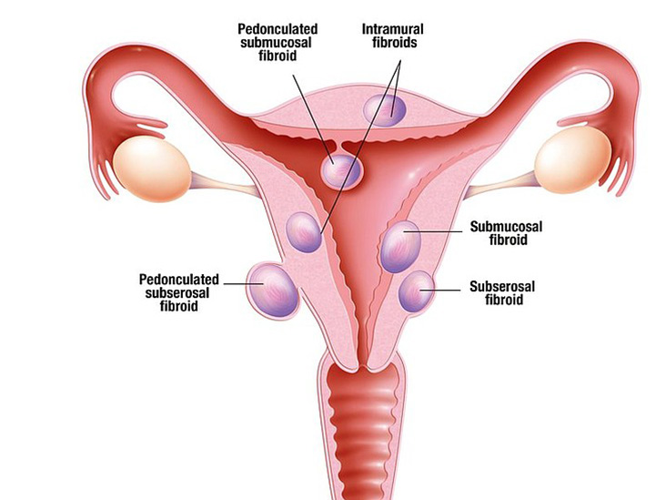 Uterine fibroids treatment in Kothrud, Karvenagar